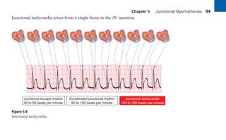 Chapter 5 Junctional Dysrhythmias 94
Junctional tachycardia arises from a single focus in the AV junction.
Figure 5-8
Junctional tachycardia.
Junctional escape rhythm
40 to 60 beats per minute
Accelerated junctional rhythm
60 to 100 beats per minute
Junctional tachycardia
100 to 180 beats per minute
sha19766_cp05.indd 94
sha19766_cp05.indd 94 7/24/06 1:51:33 PM
7/24/06 1:51:33 PM
 