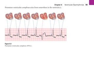 Chapter 6 Ventricular Dysrhythmias 98
Premature ventricular complexes arise from somewhere in the ventricle(s).
Figure 6-2
Premature ventricular complexes (PVCs).
sha19766_cp06.indd 98
sha19766_cp06.indd 98 7/24/06 1:55:31 PM
7/24/06 1:55:31 PM
 