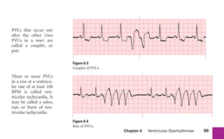 Chapter 6 Ventricular Dysrhythmias 99
PVCs that occur one
after the other (two
PVCs in a row) are
called a couplet, or
pair.
Three or more PVCs
in a row at a ventricu-
lar rate of at least 100
BPM is called ven-
tricular tachycardia. It
may be called a salvo,
run, or burst of ven-
tricular tachycardia.
Figure 6-4
Run of PVCs.
Figure 6-3
Couplet of PVCs.
sha19766_cp06.indd 99
sha19766_cp06.indd 99 7/24/06 1:55:31 PM
7/24/06 1:55:31 PM
 