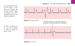 Chapter 6 Ventricular Dysrhythmias 100
Figure 6-6 R-on-T PVC.
An interpolated PVC
occurs when a PVC
does not disrupt the
normal cardiac cycle.
It appears as a PVC
squeezed between two
regular complexes.
A PVC occurring on
or near the previous
T wave is called an
R-on-T PVC.
PVC that occurs on or near the T wave can
precipitate ventricular tachycardia or fibrillation
Figure 6-5 Interpolated PVC.
sha19766_cp06.indd 100
sha19766_cp06.indd 100 7/24/06 1:55:31 PM
7/24/06 1:55:31 PM
 