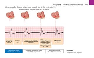 Chapter 6 Ventricular Dysrhythmias 102
Idioventricular rhythm arises from a single site in the ventricles(s).
Figure 6-8
Idioventricular rhythm.
Idioventricular rhythm arises from a single site in the ventricles.
Rate is 20 to
40 beats per
minute
Rhythm is
regular
P waves are not visible as
they are hidden in the QRS
complexes
QRS complexes are
wide and bizarre in
appearance, have T
waves in the
opposite direction of
the R wave
PR intervals
are absent
Idioventricular rhythm
20 to 40 beats per minute
Accelerated idioventricular rhythm
40 to 100 beats per minute
Ventricular tachycardia
100 to 250 beats per minute
sha19766_cp06.indd 102
sha19766_cp06.indd 102 7/24/06 1:55:32 PM
7/24/06 1:55:32 PM
 