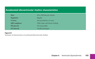 Chapter 6 Ventricular Dysrhythmias 103
Accelerated idioventricular rhythm characteristics
Rate: 40 to 100 beats per minute
Regularity: Regular
P waves: Not preceded by a P wave
QRS complexes: Wide, large, and bizarre looking
PR interval: Not measurable
QT interval: Usually prolonged
Figure 6-9
Summary of characteristics of accelerated idioventricular rhythm.
sha19766_cp06.indd 103
sha19766_cp06.indd 103 7/24/06 1:55:32 PM
7/24/06 1:55:32 PM
 