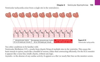 Chapter 6 Ventricular Dysrhythmias 106
Ventricular tachycardia arises from a single site in the ventricles(s).
Idioventricular rhythm
20 to 40 beats per minute
Accelerated idioventricular rhythm
40 to 100 beats per minute
Ventricular tachycardia
100 to 250 beats per minute
Two other conditions to be familiar with:
Ventricular fibrillation (VF)—results from chaotic firing of multiple sites in the ventricles. This causes the
heart muscle to quiver, much like a handful of worms, rather than contracting efficiently. On the ECG monitor
it appears like a wavy line, totally chaotic, without any logic.
Asystole—is the absense of any cardiac activity. It appears as a flat (or nearly flat) line on the monitor screen.
Figure 6-12
Ventricular tachycardia.
sha19766_cp06.indd 106
sha19766_cp06.indd 106 7/24/06 1:55:33 PM
7/24/06 1:55:33 PM
 