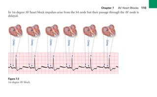 Chapter 7 AV Heart Blocks 110
In 1st-degree AV heart block impulses arise from the SA node but their passage through the AV node is
delayed.
Figure 7-2
1st-degree AV block.
Delay
Delay
Delay
Delay
Delay
Delay
sha19766_cp07.indd 110
sha19766_cp07.indd 110 7/24/06 1:59:52 PM
7/24/06 1:59:52 PM
 