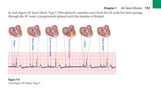 Chapter 7 AV Heart Blocks 112
In 2nd-degree AV heart block, Type I (Wenckebach), impulses arise from the SA node but their passage
through the AV node is progressively delayed until the impulse is blocked.
Figure 7-4
2nd-degree AV block, Type I. Delay
Mor
e
dela
y
Even
more
delay
Impulse
is
blocked
Blocked
Delay
More
delay
sha19766_cp07.indd 112
sha19766_cp07.indd 112 7/24/06 1:59:52 PM
7/24/06 1:59:52 PM
 
