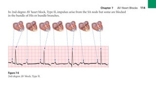 Chapter 7 AV Heart Blocks 114
In 2nd-degree AV heart block, Type II, impulses arise from the SA node but some are blocked
in the bundle of His or bundle branches.
Figure 7-6
2nd-degree AV block, Type II.
Blocked
Blocked
Blocked
sha19766_cp07.indd 114
sha19766_cp07.indd 114 7/24/06 1:59:52 PM
7/24/06 1:59:52 PM
 