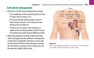 Chapter 9 Hypertrophy, Bundle Branch Block, and Preexcitation 128
Left atrial enlargement
• Indicators of left atrial enlargement include:
∞ The amplitude of the terminal portion of the
P wave may increase in V1.
∞ The terminal (left atrial) portion of the P
wave drops at least 1 mm below the iso-
electric line (in lead V1).
∞ There is an increase in the duration or
width of the terminal portion of the P wave
of at least one small square (0.04 seconds).
• Often the presence of ECG evidence of left
atrial enlargement only reflects a nonspecific
conduction irregularity. However, it may also
be the result of mitral valve stenosis causing
the left atria to enlarge to force blood across
the stenotic (tight) mitral valve.
Figure 9-2
Left atrial enlargement leads to an increase in the amplitude
and width of the terminal part of the P wave.
+
+
Left atrial
enlargement
P wave
Lead II
Lead V1
Broad
P wave
Biphasic
P wave
V1–V2
Notched P wave
(P mitrale)
I, II, and V4–V6
sha19766_cp09.indd 128
sha19766_cp09.indd 128 7/24/06 2:10:00 PM
7/24/06 2:10:00 PM
 