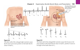 Chapter 9 Hypertrophy, Bundle Branch Block, and Preexcitation 130
Right ventricular
hypertrophy
Starting with V1, the waveforms take an
upward deflection but then moving toward
V6 the waveforms take a downward
deflection
V1 V2 V3 V4
S
R
Figure 9-4
The thick wall of the enlarged right ventricle causes
the R waves to be more positive in the leads that lie
closer to lead V1.
Mean QRS axis
+180° 0°
–90°
The mean QRS axis moves
farther leftward resulting in
left axis deviation
R
S
V1 V2 V3 V4 V5 V6
+90°
Left ventricular
hypertrophy
Figure 9-5
The thick wall of the enlarged left ventricle causes the R waves to be
more positive in the leads that lie closer to lead V6 and the S waves to
be larger in the leads closer to V1.
V1 V2 V3 V4 V5 V6
S
R
sha19766_cp09.indd 130
sha19766_cp09.indd 130 7/24/06 2:10:00 PM
7/24/06 2:10:00 PM
 