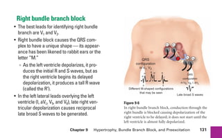 Chapter 9 Hypertrophy, Bundle Branch Block, and Preexcitation 131
Right bundle branch block
• The best leads for identifying right bundle
branch are V1 and V2.
• Right bundle block causes the QRS com-
plex to have a unique shape — its appear-
ance has been likened to rabbit ears or the
letter “M.”
∞ As the left ventricle depolarizes, it pro-
duces the initial R and S waves, but as
the right ventricle begins its delayed
depolarization, it produces a tall R wave
(called the R„).
• In the left lateral leads overlying the left
ventricle (I, aVL, V5, and V6), late right ven-
tricular depolarization causes reciprocal
late broad S waves to be generated.
Figure 9-6
In right bundle branch block, conduction through the
right bundle is blocked causing depolarization of the
right ventricle to be delayed; it does not start until the
left ventricle is almost fully depolarized.
+ +
+
+
V1 V2
V5 V6
R
R R
S
S
S
R⬘ R⬘
r⬘
Block
QRS
configuration
in V5, V6, I, aVL
QRS
configuration
in V1, V2
Late broad S waves
Different M-shaped configurations
that may be seen
sha19766_cp09.indd 131
sha19766_cp09.indd 131 7/24/06 2:10:01 PM
7/24/06 2:10:01 PM
 
