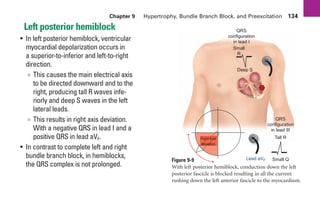 Chapter 9 Hypertrophy, Bundle Branch Block, and Preexcitation 134
Left posterior hemiblock
• In left posterior hemiblock, ventricular
myocardial depolarization occurs in
a superior-to-inferior and left-to-right
direction.
∞ This causes the main electrical axis
to be directed downward and to the
right, producing tall R waves infe-
riorly and deep S waves in the left
lateral leads.
∞ This results in right axis deviation.
With a negative QRS in lead I and a
positive QRS in lead aVF.
• In contrast to complete left and right
bundle branch block, in hemiblocks,
the QRS complex is not prolonged.
+
+
Block
Right axis
deviation
Small Q
Tall R
QRS
configuration
in lead III
Deep S
Small
R
QRS
configuration
in lead I
Lead aVF
Figure 9-9
With left posterior hemiblock, conduction down the left
posterior fascicle is blocked resulting in all the current
rushing down the left anterior fascicle to the myocardium.
sha19766_cp09.indd 134
sha19766_cp09.indd 134 7/24/06 2:10:02 PM
7/24/06 2:10:02 PM
 