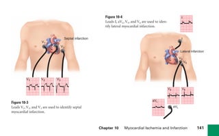 Chapter 10 Myocardial Ischemia and Infarction 141
Figure 10-3
Leads V1, V2, and V3 are used to identify septal
myocardial infarction.
+
+
+
V1
V2 V3
V1 V2 V3
Septal infarction
+
+
+
+
aVL
V5
I
V6
aVL
V5 V6
I
Lateral infarction
Figure 10-4
Leads I, aVL, V5, and V6 are used to iden-
tify lateral myocardial infarction.
sha19766_cp10.indd 141
sha19766_cp10.indd 141 7/24/06 2:17:16 PM
7/24/06 2:17:16 PM
 