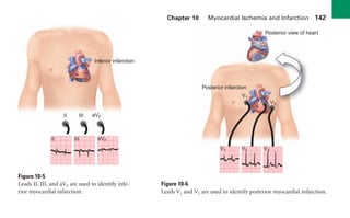 Chapter 10 Myocardial Ischemia and Infarction 142
Figure 10-5
Leads II, III, and aVF are used to identify infe-
rior myocardial infarction.
Figure 10-6
Leads V1 and V2 are used to identify posterior myocardial infarction.
+ + +
Inferior infarction
II III aVF
II III aVF
+
+
V1 V2 V3
Posterior infarction
Posterior view of heart
+
V1
V2 V3
sha19766_cp10.indd 142
sha19766_cp10.indd 142 7/24/06 2:17:16 PM
7/24/06 2:17:16 PM
 