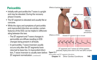 Chapter 11 Other Cardiac Conditions 145
Pericarditis
• Initially with pericarditis the T wave is upright
and may be elevated. During the recovery
phase it inverts.
• The ST segment is elevated and usually flat or
concave.
• While the signs and symptoms of pericarditis
and myocardial infarction are similar, certain
features of the ECG can be helpful in differenti-
ating between the two:
∞ The ST segment and T wave changes in
pericarditis are diffuse resulting in ECG
changes being present in all leads.
∞ In pericarditis, T wave inversion usually
occurs only after the ST segments have
returned to base line. In myocardial infarc-
tion, T wave inversion is usually seen before
ST segment normalization. (continued)
Effects on ECG
Effects of pericarditis on the heart
Normal
pericardium
Enlarged view
Inflamed
pericardium
ST segments and T waves are off the baseline,
gradually angling back down to the next QRS complex
Elevated ST segment is flat or concave
Figure 11-1
Pericarditis and ST segment elevation.
sha19766_cp11.indd 145
sha19766_cp11.indd 145 7/24/06 2:39:38 PM
7/24/06 2:39:38 PM
 