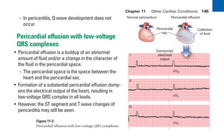 Chapter 11 Other Cardiac Conditions 146
∞ In pericarditis, Q wave development does not
occur.
Pericardial effusion with low-voltage
QRS complexes
• Pericardial effusion is a buildup of an abnormal
amount of fluid and/or a change in the character of
the fluid in the pericardial space.
∞ The pericardial space is the space between the
heart and the pericardial sac.
• Formation of a substantial pericardial effusion damp-
ens the electrical output of the heart, resulting in
low-voltage QRS complex in all leads.
• However, the ST segment and T wave changes of
pericarditis may still be seen.
I
aVR
aVL
aVF
II
III
Pericardial
sac
Collection
of fluid
Normal pericardium Pericardial effusion
Dampened
electrical
output
Figure 11-2
Pericardial effusion with low-voltage QRS complexes.
sha19766_cp11.indd 146
sha19766_cp11.indd 146 7/24/06 2:39:39 PM
7/24/06 2:39:39 PM
 