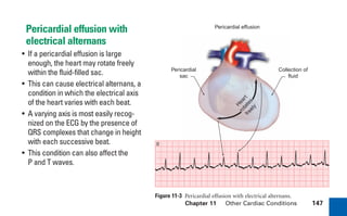 Chapter 11 Other Cardiac Conditions 147
Pericardial effusion with
electrical alternans
• If a pericardial effusion is large
enough, the heart may rotate freely
within the fluid-filled sac.
• This can cause electrical alternans, a
condition in which the electrical axis
of the heart varies with each beat.
• A varying axis is most easily recog-
nized on the ECG by the presence of
QRS complexes that change in height
with each successive beat.
• This condition can also affect the
P and T waves.
Figure 11-3 Pericardial effusion with electrical alternans.
Pericardial effusion
H
e
a
r
t
r
o
t
a
t
e
s
f
r
e
e
l
y
Pericardial
sac
Collection of
fluid
II
sha19766_cp11.indd 147
sha19766_cp11.indd 147 7/24/06 2:39:39 PM
7/24/06 2:39:39 PM
 