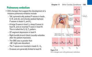 Chapter 11 Other Cardiac Conditions 148
Pulmonary embolism
• ECG changes that suggest the development of a
massive pulmonary embolus include:
∞ Tall, symmetrically peaked P waves in leads
II, III, and aVF and sharply peaked biphasic
P waves in leads V1 and V2.
∞ A large S wave in lead I, a deep Q wave in
lead III, and an inverted T wave in lead III.
This is called the S1 Q3 T3 pattern.
∞ ST segment depression in lead II.
∞ Right bundle branch block (usually subsides
after the patient improves).
∞ The QRS axis is greater than
+90° (right axis deviation).
∞ The T waves are inverted in leads V1–V4.
∞ Q waves are generally limited to lead III.
Embolus S1Q3T3
Large S wave
in lead I
ST segment
depression
in lead II
Large Q wave
in lead III with
T wave inversion
Right bundle branch
block in leads V1–V4
T wave inversion
in leads V1–V4
V1 V2 V3 V4
Figure 11-4
ECG changes seen with pulmonary embolism.
sha19766_cp11.indd 148
sha19766_cp11.indd 148 7/24/06 2:39:39 PM
7/24/06 2:39:39 PM
 