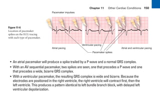 Chapter 11 Other Cardiac Conditions 150
• An atrial pacemaker will produce a spike trailed by a P wave and a normal QRS complex.
• With an AV sequential pacemaker, two spikes are seen, one that precedes a P wave and one
that precedes a wide, bizarre QRS complex.
• With a ventricular pacemaker, the resulting QRS complex is wide and bizarre. Because the
electrodes are positioned in the right ventricle, the right ventricle will contract first, then the
left ventricle. This produces a pattern identical to left bundle branch block, with delayed left
ventricular depolarization.
Figure 11-6
Location of pacemaker
spikes on the ECG tracing
with each type of pacemaker.
Atrial pacing
Pacemaker impulses
Ventricular pacing
Pacemaker spikes
Atrial and ventricular pacing
sha19766_cp11.indd 150
sha19766_cp11.indd 150 7/24/06 2:39:40 PM
7/24/06 2:39:40 PM
 