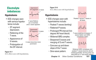 Electrolyte
imbalances
Hypokalemia
• ECG changes seen
with serious hypoka-
lemia include:
∞ ST segment
depression.
∞ Flattening of the
T wave.
∞ Appearance of
U waves.
∞ Prolongation of
the QT interval.
Figure 11-7
ECG effects seen with hypokalemia.
T wave flattens
(or is inverted)
and U wave appears
U wave becomes more
prominent
Depressed
ST segment U wave
U wave
Depressed
ST segment
Peaked, narrow T waves in
all leads
T wave peaking increases, P
waves flatten and QRS
complexes widen
Widened QRS complexes and
peaked T waves become almost
indistinguishable, forming what are
described as a “sine-wave pattern”
Hyperkalemia
• ECG changes seen with
hyperkalemia include:
∞ Peaked T waves (tenting).
∞ Flattened P waves.
∞ Prolonged PR interval (1st-
degree AV heart block).
∞ Widened QRS complex.
∞ Deepened S waves and
merging of S and T waves.
∞ Concave up and down
slope of the T wave.
∞ Sine-wave pattern.
Figure 11-8
ECG effects seen with hyperkalemia.
Chapter 11 Other Cardiac Conditions 151
sha19766_cp11.indd 151
sha19766_cp11.indd 151 7/24/06 2:39:40 PM
7/24/06 2:39:40 PM
 
