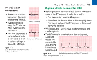 Chapter 11 Other Cardiac Conditions 152
Hypercalcemia/
Hypocalcemia
• Alterations in serum
calcium levels mainly
affect the QT interval.
• Hypocalcemia pro-
longs the QT interval
while hypercalcemia
shortens it.
• Torsades de pointes, a
variant of ventricular
tachycardia, is seen
in patients with pro-
longed QT intervals.
Figure 11-9
ECG effects seen with hypocalcemia
and hypercalcemia.
Short QT interval
Prolonged QT interval
Gradual downward curve of the ST segment
Digoxin effects seen on the ECG
• Digoxin produces a characteristic gradual downward
curve of the ST segment (it looks like a ladle).
∞ The R wave slurs into the ST segment.
∞ Sometimes the T wave is lost in this scooping effect.
The lowest portion of the ST segment is depressed
below the baseline.
• When seen, the T waves have shorter amplitude and
can be biphasic.
• The QT interval is usually shorter than anticipated,
and the U
waves are
more visible.
Also, the PR
interval may
be prolonged.
Figure 11-10
Effects of digoxin on the ECG.
sha19766_cp11.indd 152
sha19766_cp11.indd 152 7/24/06 2:39:40 PM
7/24/06 2:39:40 PM
 