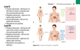 Chapter 1 The Electrocardiogram 12
Lead II
• Positive electrode—left leg (or on
left side of chest in midclavicular
line just beneath last rib).
• Negative electrode—right arm (or
below right clavicle).
• Ground electrode—left arm (or
below left clavicle).
• Waveforms are positive.
Lead III
• Positive electrode—left leg (or left
side of the chest in midclavicular
line just beneath last rib).
• Negative electrode—left arm (or
below left clavicle).
• Ground electrode—right arm (or
below right clavicle).
• Waveforms are positive or
biphasic.
LA
+
–
RA LA
LL
+
–
+
–
+
–
G
G
RA
LL
= Upright
waveforms
= Upright or
biphasic
waveforms
Impulses
moving
toward
the
positive
lead
Impulses
intersect
with
negative
to positive
layout of
ECG
leads
B
C Lead III
Lead II
v
i
e
w
v
i
e
w
view
view
or
or
=
=
Figure 1-8 (a) Lead I. (b) Lead II. (c) Lead III.
sha19766_cp01.indd 12
sha19766_cp01.indd 12 7/24/06 1:19:44 PM
7/24/06 1:19:44 PM
 