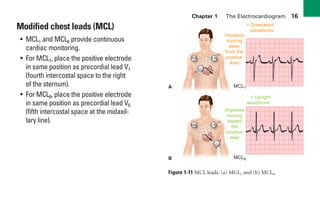 Chapter 1 The Electrocardiogram 16
Modified chest leads (MCL)
• MCL1 and MCL6 provide continuous
cardiac monitoring.
• For MCL1, place the positive electrode
in same position as precordial lead V1
(fourth intercostal space to the right
of the sternum).
• For MCL6, place the positive electrode
in same position as precordial lead V6
(fifth intercostal space at the midaxil-
lary line).
Impulses
moving
away
from the
positive
lead
Impulses
moving
toward
the
positive
lead
= Downward
waveforms
= Upright
waveforms
MCL1
MCL6
RA
LL
+
–
A
LA
B
LA
+
–
RA
LL
G
G
Figure 1-11 MCL leads. (a) MCL1 and (b) MCL6.
sha19766_cp01.indd 16
sha19766_cp01.indd 16 7/24/06 1:19:44 PM
7/24/06 1:19:44 PM
 