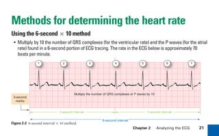Chapter 2 Analyzing the ECG 21
Methods for determining the heart rate
Using the 6-second!10 method
• Multiply by 10 the number of QRS complexes (for the ventricular rate) and the P waves (for the atrial
rate) found in a 6-second portion of ECG tracing. The rate in the ECG below is approximately 70
beats per minute.
3-second interval 3-second interval
Multiply the number of QRS complexes or P waves by 10
6-second interval
3-second
marks
1 2 3 4 5 6 7
Figure 2-2 6-second interval!10 method.
sha19766_cp02.indd 21
sha19766_cp02.indd 21 7/24/06 1:48:20 PM
7/24/06 1:48:20 PM
 