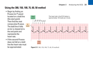 Chapter 2 Analyzing the ECG 22
Using the 300, 150, 100, 75, 60, 50 method
Figure 2-3 300, 150, 100, 75, 60, 50 method.
3
0
0
1
5
0
1
0
0
7
5
6
0
5
0
R
wave
End
point
Start
point
The heart rate in the ECG below is
approximately 100 beats per minute.
• Begin by finding an
R wave (or P wave)
located on a bold line
(the start point).
Then find the next
consecutive R wave.
The bold line it falls
on (or is closest to) is
the end point and
represents the
heart rate.
• If the second R wave
does not fall on a bold
line the heart rate must
be approximated.
sha19766_cp02.indd 22
sha19766_cp02.indd 22 7/24/06 1:48:20 PM
7/24/06 1:48:20 PM
 