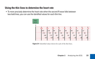 Chapter 2 Analyzing the ECG 23
Using the thin lines to determine the heart rate
Figure 2-4 Identified values shown for each of the thin lines.
• To more precisely determine the heart rate when the second R wave falls between
two bold lines, you can use the identified values for each thin line.
300 150 100 75 60 50 43 38 33
250
214
188
167
136
125
115
107
94
88
84
79
72
68
65
63
58
56
54
52
48
47
45
44
42
41
40
39
37
36
35
34
Start
point
sha19766_cp02.indd 23
sha19766_cp02.indd 23 7/24/06 1:48:20 PM
7/24/06 1:48:20 PM
 