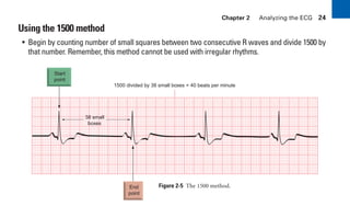 Chapter 2 Analyzing the ECG 24
Using the 1500 method
• Begin by counting number of small squares between two consecutive R waves and divide 1500 by
that number. Remember, this method cannot be used with irregular rhythms.
End
point
Start
point
38 small
boxes
1500 divided by 38 small boxes = 40 beats per minute
Figure 2-5 The 1500 method.
sha19766_cp02.indd 24
sha19766_cp02.indd 24 7/24/06 1:48:20 PM
7/24/06 1:48:20 PM
 