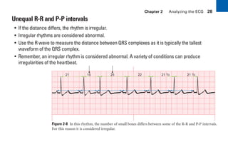 Chapter 2 Analyzing the ECG 28
Unequal R-R and P-P intervals
• If the distance differs, the rhythm is irregular.
• Irregular rhythms are considered abnormal.
• Use the R wave to measure the distance between QRS complexes as it is typically the tallest
waveform of the QRS complex.
• Remember, an irregular rhythm is considered abnormal. A variety of conditions can produce
irregularities of the heartbeat.
Figure 2-8 In this rhythm, the number of small boxes differs between some of the R-R and P-P intervals.
For this reason it is considered irregular.
21 25 22 21 1/2 21 1/2
15
sha19766_cp02.indd 28
sha19766_cp02.indd 28 7/24/06 1:48:21 PM
7/24/06 1:48:21 PM
 