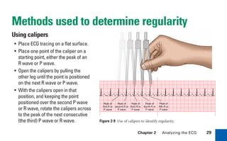 Chapter 2 Analyzing the ECG 29
Methods used to determine regularity
Using calipers
• Place ECG tracing on a flat surface.
• Place one point of the caliper on a
starting point, either the peak of an
R wave or P wave.
• Open the calipers by pulling the
other leg until the point is positioned
on the next R wave or P wave.
• With the calipers open in that
position, and keeping the point
positioned over the second P wave
or R wave, rotate the calipers across
to the peak of the next consecutive
(the third) P wave or R wave. Figure 2-9 Use of calipers to identify regularity.
Peak of
first R or
P wave
Peak of
second R or
P wave
Peak of
third R or
P wave
Peak of
fourth R or
P wave
Peak of
fifth R or
P wave
sha19766_cp02.indd 29
sha19766_cp02.indd 29 7/24/06 1:48:21 PM
7/24/06 1:48:21 PM
 