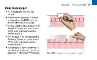 Chapter 2 Analyzing the ECG 30
Using paper and pen
• Place the ECG tracing on a flat
surface.
• Position the straight edge of a piece
of paper above the ECG tracing so
that the intervals are still visible.
• Identify a starting point, the peak of an
R wave or P wave, and place a mark
on the paper in the corresponding
position above it.
• Find the peak of the next consecutive
R wave or P wave, and place a mark
on the paper in the corresponding
position above it.
• Move the paper across the ECG trac-
ing, aligning the two marks with suc-
ceeding R-R intervals or P-P intervals. Figure 2-10 Use of paper and pen to identify regularity.
sha19766_cp02.indd 30
sha19766_cp02.indd 30 7/24/06 1:48:22 PM
7/24/06 1:48:22 PM
 