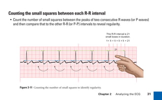 Chapter 2 Analyzing the ECG 31
Counting the small squares between each R-R interval
• Count the number of small squares between the peaks of two consecutive R waves (or P waves)
and then compare that to the other R-R (or P-P) intervals to reveal regularity.
Figure 2-11 Counting the number of small squares to identify regularity.
1+ 5 + 5 + 5 + 5 = 21
This R-R interval is 21
small boxes in duration.
21
sha19766_cp02.indd 31
sha19766_cp02.indd 31 7/24/06 1:48:23 PM
7/24/06 1:48:23 PM
 
