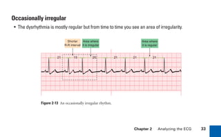Chapter 2 Analyzing the ECG 33
Occasionally irregular
• The dysrhythmia is mostly regular but from time to time you see an area of irregularity.
Figure 2-13 An occasionally irregular rhythm.
21 25 21 21 21
15
Area where
it is irregular
Area where
it is regular
Shorter
R-R interval
sha19766_cp02.indd 33
sha19766_cp02.indd 33 7/24/06 1:48:23 PM
7/24/06 1:48:23 PM
 