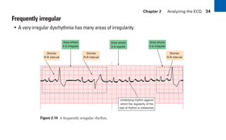Chapter 2 Analyzing the ECG 34
Frequently irregular
• A very irregular dysrhythmia has many areas of irregularity.
Figure 2-14 A frequently irregular rhythm.
Shorter
R-R interval
Shorter
R-R interval
Area where
it is irregular
Area where
it is regular
Underlying rhythm against
which the regularity of the
rest of rhythm is measured.
Area where
it is irregular
Shorter
R-R interval
sha19766_cp02.indd 34
sha19766_cp02.indd 34 7/24/06 1:48:23 PM
7/24/06 1:48:23 PM
 