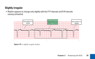 Chapter 2 Analyzing the ECG 35
Slightly irregular
• Rhythm appears to change only slightly with the P-P intervals and R-R intervals
varying somewhat.
Figure 2-15 A slightly irregular rhythm.
Area where it is
regular
Area where it is
slightly irregular
Area where it is
regular
sha19766_cp02.indd 35
sha19766_cp02.indd 35 7/24/06 1:48:23 PM
7/24/06 1:48:23 PM
 