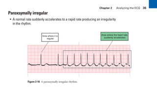 Chapter 2 Analyzing the ECG 36
Paroxsymally irregular
• A normal rate suddenly accelerates to a rapid rate producing an irregularity
in the rhythm.
Figure 2-16 A paroxsymally irregular rhythm.
Area where it is
regular
Area where the heart rate
suddenly accelerates
sha19766_cp02.indd 36
sha19766_cp02.indd 36 7/24/06 1:48:23 PM
7/24/06 1:48:23 PM
 