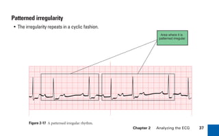Chapter 2 Analyzing the ECG 37
Patterned irregularity
• The irregularity repeats in a cyclic fashion.
Figure 2-17 A patterned irregular rhythm.
Area where it is
patterned irregular
sha19766_cp02.indd 37
sha19766_cp02.indd 37 7/24/06 1:48:23 PM
7/24/06 1:48:23 PM
 