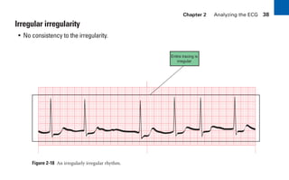 Chapter 2 Analyzing the ECG 38
Irregular irregularity
• No consistency to the irregularity.
Figure 2-18 An irregularly irregular rhythm.
Entire tracing is
irregular
sha19766_cp02.indd 38
sha19766_cp02.indd 38 7/24/06 1:48:23 PM
7/24/06 1:48:23 PM
 