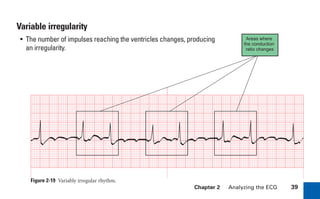 Chapter 2 Analyzing the ECG 39
Areas where
the conduction
ratio changes
Variable irregularity
• The number of impulses reaching the ventricles changes, producing
an irregularity.
Figure 2-19 Variably irregular rhythm.
sha19766_cp02.indd 39
sha19766_cp02.indd 39 7/24/06 1:48:23 PM
7/24/06 1:48:23 PM
 
