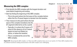 Chapter 2 Analyzing the ECG 44
A
0.10 seconds
in duration
0.12 seconds
in duration
S
S
Q
J point
J point
R
R
B
0.08 seconds
in duration
0.08 seconds
in duration
0.14 seconds
in duration
0.22 seconds
in duration
0.18
seconds
in duration
S
S
S
Q
J point
J point
J point
J point
J point
R
R
R
S
S
R
R
Measuring the QRS complex
• First identify the QRS complex with the longest duration and
most distinct beginning and ending.
• Start by finding the beginning of the QRS complex.
∞ This is the point where the first wave of the complex (where
either the Q or R wave) begins to deviate from the baseline.
• Then measure to the point where the last
wave of the complex transitions into the
ST segment (referred to as the J point).
∞ Typically, it is where the S wave or R
wave (in the absence of an S wave)
begins to level out (flatten) at,
above, or below the baseline.
∞ This is considered the end of the
QRS complex.
Figure 2-24 Measuring the QRS complex. (a) These two QRS complexes have easy to see J points. (b) These QRS complexes have
less defined transitions making measurement of the QRS complex more challenging.
sha19766_cp02.indd 44
sha19766_cp02.indd 44 7/24/06 1:48:24 PM
7/24/06 1:48:24 PM
 