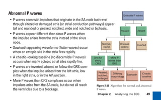 Chapter 2 Analyzing the ECG 49
One for
every
QRS
More P
waves than
QRS
Absent
Normal,
round
Unusual
looking
Inverted
Peaked,
notched,
enlarged
Differing
morphology
Sawtooth Chaotic
baseline
Evaluate P waves
Present
Abnormal P waves
• P waves seen with impulses that originate in the SA node but travel
through altered or damaged atria (or atrial conduction pathways) appear
tall and rounded or peaked, notched, wide and notched or biphasic.
Figure 2-29 Algorithm for normal and abnormal
P waves.
• P waves appear different than sinus P waves when
the impulse arises from the atria instead of the sinus
node.
• Sawtooth appearing waveforms (flutter waves) occur
when an ectopic site in the atria fires rapidly.
• A chaotic-looking baseline (no discernible P waves)
occurs when many ectopic atrial sites rapidly fire.
• P waves are inverted, absent, or follow the QRS com-
plex when the impulse arises from the left atria, low
in the right atria, or in the AV junction.
• More P waves than QRS complexes occur when
impulses arise from the SA node, but do not all reach
the ventricles due to a blockage.
sha19766_cp02.indd 49
sha19766_cp02.indd 49 7/24/06 1:48:25 PM
7/24/06 1:48:25 PM
 