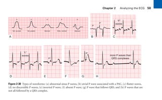 Chapter 2 Analyzing the ECG 50
Figure 2-30 Types of waveforms: (a) abnormal sinus P waves, (b) atrial P wave associated with a PAC, (c) flutter waves,
(d) no discernible P waves, (e) inverted P wave, (f) absent P wave, (g) P wave that follows QRS, and (h) P waves that are
not all followed by a QRS complex.
P
P⬘
P
Tall, rounded Tall, peaked Notched Wide, notched Biphasic
P P P P
P⬘
P⬘
A B C
E
“f ”
waves
“F”
waves
more P waves than
QRS complexes
F G H
D
sha19766_cp02.indd 50
sha19766_cp02.indd 50 7/24/06 1:48:25 PM
7/24/06 1:48:25 PM
 