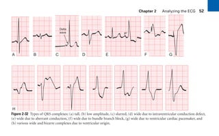 Delta
wave
A B C D E F G
H
P„
Figure 2-32 Types of QRS complexes: (a) tall, (b) low amplitude, (c) slurred, (d) wide due to intraventricular conduction defect,
(e) wide due to aberrant conduction, (f) wide due to bundle branch block, (g) wide due to ventricular cardiac pacemaker, and
(h) various wide and bizarre complexes due to ventricular origin.
Chapter 2 Analyzing the ECG 52
sha19766_cp02.indd 52
sha19766_cp02.indd 52 7/24/06 1:48:25 PM
7/24/06 1:48:25 PM
 