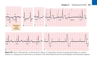 Chapter 2 Analyzing the ECG 54
Figure 2-34 Types of PR intervals: (a) shortened, (b) absent, (c) longer than normal, (d) progressively longer in a cyclical
manner, (e) varying, and (f) absent due to an absence in the relationship between the atrial impulses and ventricular impulses.
0.18 0.10
Premature
atrial
complex
P⬘ P
0.30 0.35 0.42 absent 0.19
P P P P
0.20
P⬘
0.16
P⬘
0.12
P⬘
0.14
P⬘ P P P P P P P
A B C D
E F
sha19766_cp02.indd 54
sha19766_cp02.indd 54 7/24/06 1:48:25 PM
7/24/06 1:48:25 PM
 