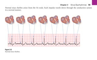 Chapter 3 Sinus Dysrhythmias 58
Normal sinus rhythm arises from the SA node. Each impulse travels down through the conduction system
in a normal manner.
Figure 3-2
Normal sinus rhythm.
sha19766_cp03.indd 58
sha19766_cp03.indd 58 7/24/06 11:37:15 AM
7/24/06 11:37:15 AM
 