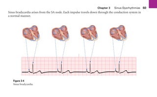 Chapter 3 Sinus Dysrhythmias 60
Sinus bradycardia arises from the SA node. Each impulse travels down through the conduction system in
a normal manner.
Figure 3-4
Sinus bradycardia.
sha19766_cp03.indd 60
sha19766_cp03.indd 60 7/24/06 11:37:15 AM
7/24/06 11:37:15 AM
 