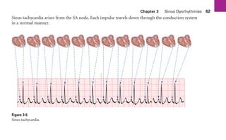 Chapter 3 Sinus Dysrhythmias 62
Sinus tachycardia arises from the SA node. Each impulse travels down through the conduction system
in a normal manner.
Figure 3-6
Sinus tachycardia.
sha19766_cp03.indd 62
sha19766_cp03.indd 62 7/24/06 11:37:16 AM
7/24/06 11:37:16 AM
 