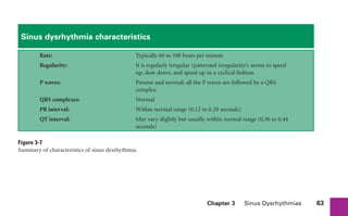 Chapter 3 Sinus Dysrhythmias 63
Sinus dysrhythmia characteristics
Rate: Typically 60 to 100 beats per minute
Regularity: It is regularly irregular (patterned irregularity); seems to speed
up, slow down, and speed up in a cyclical fashion
P waves: Present and normal; all the P waves are followed by a QRS
complex
QRS complexes: Normal
PR interval: Within normal range (0.12 to 0.20 seconds)
QT interval: May vary slightly but usually within normal range (0.36 to 0.44
seconds)
Figure 3-7
Summary of characteristics of sinus dysrhythmia.
sha19766_cp03.indd 63
sha19766_cp03.indd 63 7/24/06 11:37:16 AM
7/24/06 11:37:16 AM
 