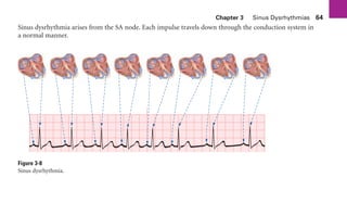 Chapter 3 Sinus Dysrhythmias 64
Sinus dysrhythmia arises from the SA node. Each impulse travels down through the conduction system in
a normal manner.
Figure 3-8
Sinus dysrhythmia.
sha19766_cp03.indd 64
sha19766_cp03.indd 64 7/24/06 11:37:16 AM
7/24/06 11:37:16 AM
 